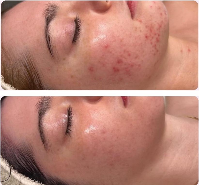 Before and after Microfix facial treatment